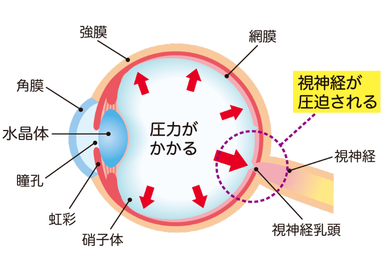 緑内障とは